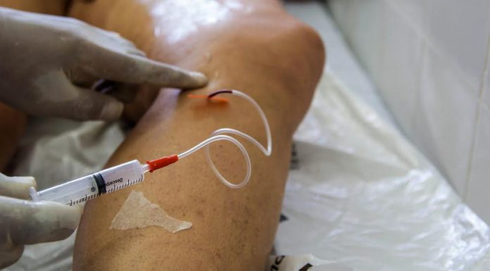 A cada dia, 145 mulheres são internadas para tratar varizes